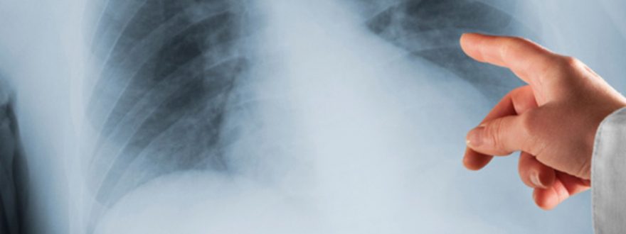 COPD, or chronic obstructive pulmonary disease, is a progressive lung disease that causes coughing, sputum production, wheezing, shortness of breath, chest tightness, and other symptoms.