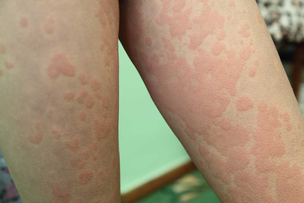 Hives, the common term for urticaria, may appear as blotches or raised red bumps (wheals), caused by irritation in the upper layers of the skin.