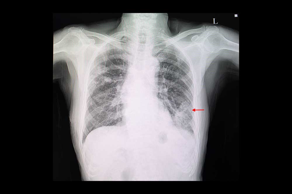 You may be referred to a MLA physician due to findings of a lung nodule on imaging.  A lung (pulmonary) nodule is an abnormal growth that forms in a lung.