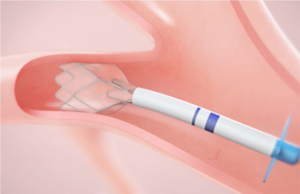 The Zephyr Valve treatment is a procedure that allows a doctor to place one or more small valves in your airways, which release trapped pockets of air to improve your ability to breathe.